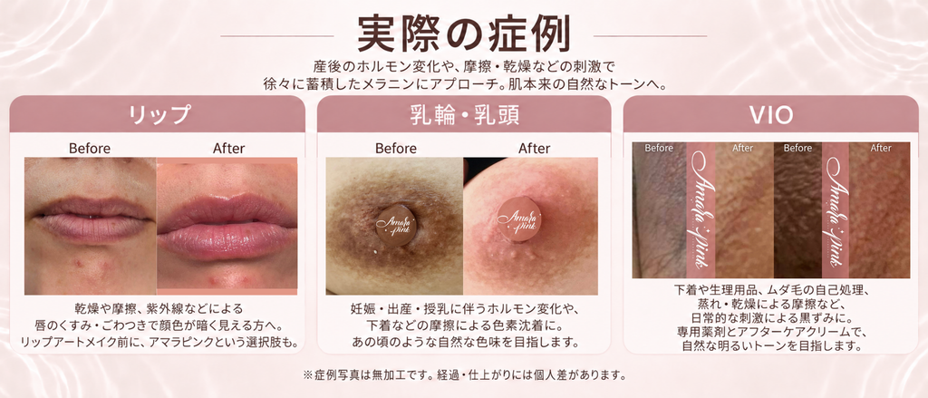 アマラピンクの乳輪・乳頭とVIOの症例。施術前後の色味を比較した写真。経過・仕上がりには個人差があります。